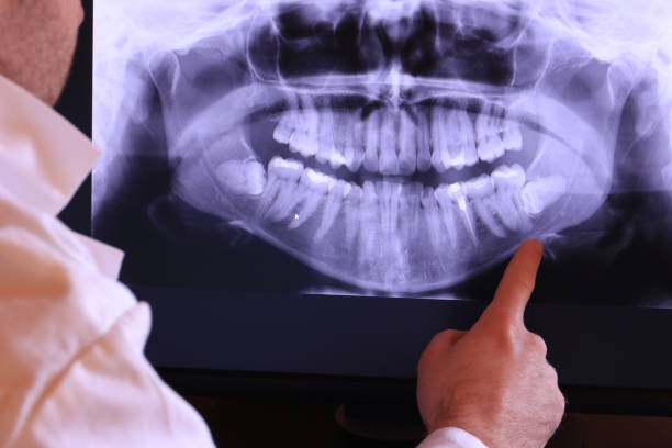 Best Knocked-Out Tooth (Avulsed Tooth) Treatment in Ellis, KS